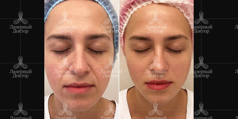 биоревитализация