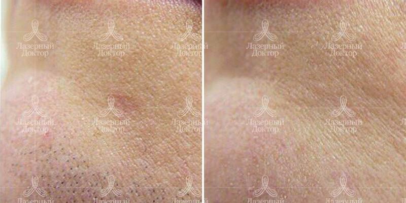 Удаление волос на лице лазером навсегда (результат на фото)