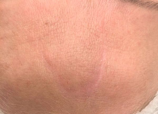 Лазерное удаление шрамов