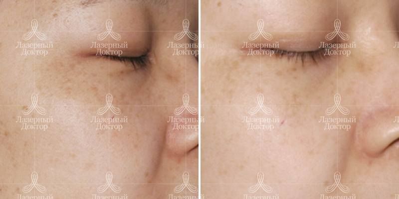 Лазерное удаление пигментации (фото)