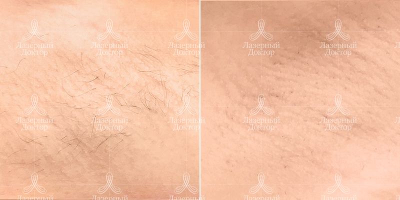 лазерная эпиляция 