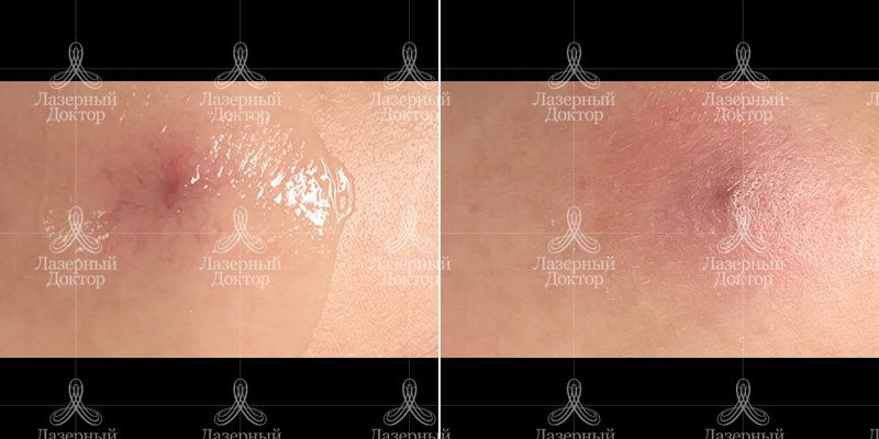 Удаление сосудов