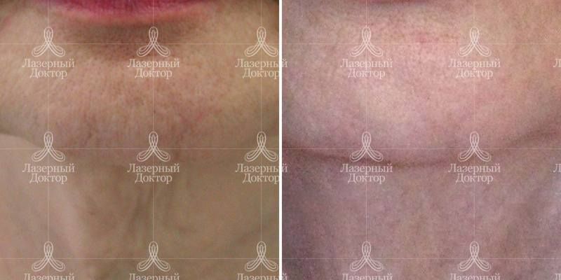 infini омоложение