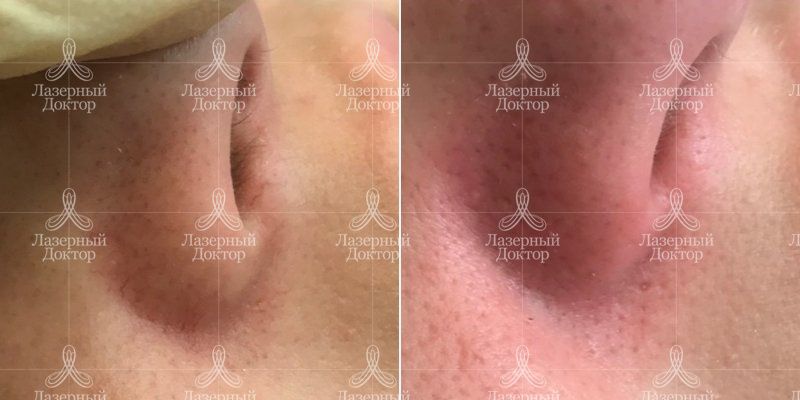 Удаление сосудов