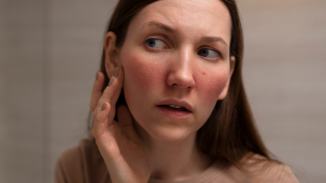 Купероз на лице: причины, симптомы, лечение