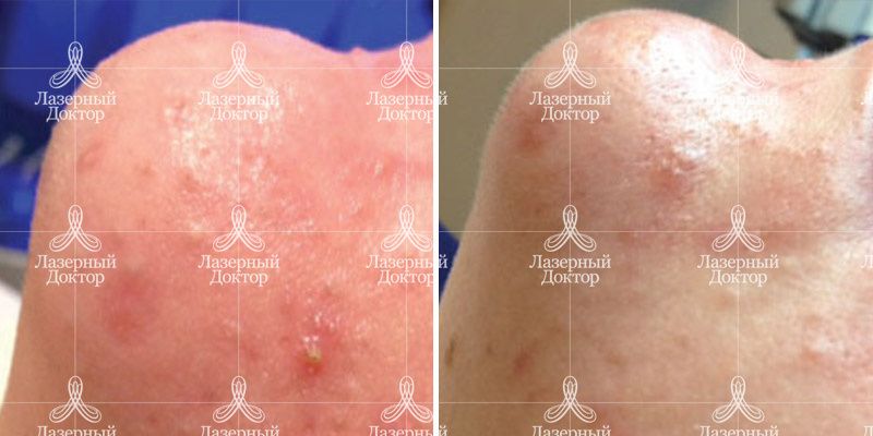 HydraFacial (до и после)