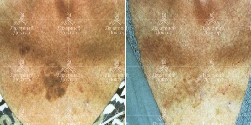 Фотоомоложение на аппарате quantum (шея)