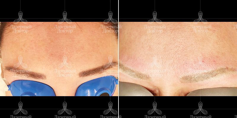 удаление татуажа бровей