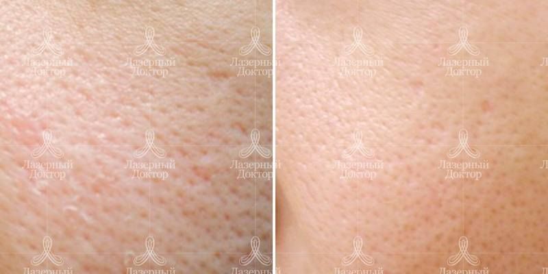 Карбоновый пилинг: до и после процедуры