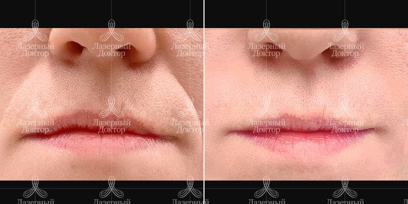 контурная пластика губ