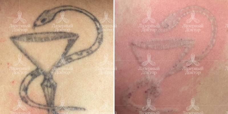 Лазерное удаление татуировки на плече