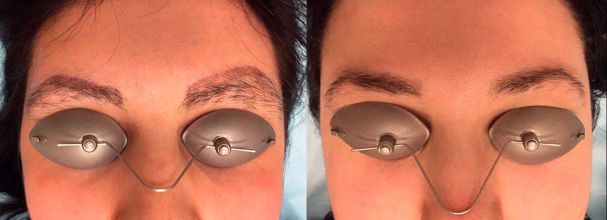 Лазерное удаление татуажа