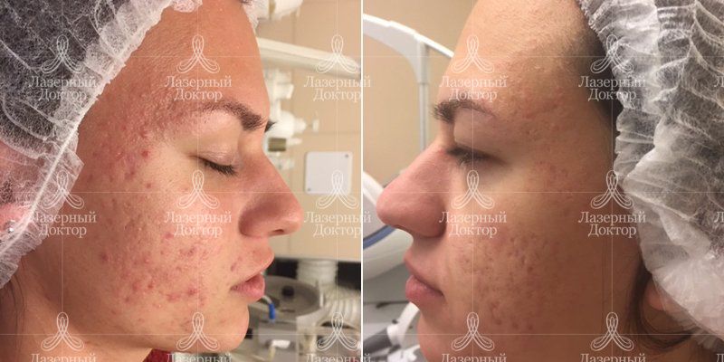 Удаление шрамов