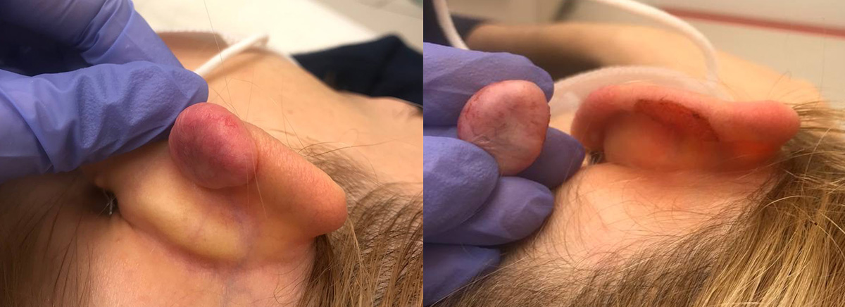 удаление новообразования