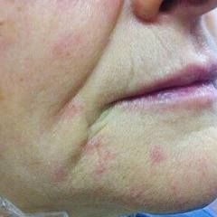 Удаление телеангиэктазий