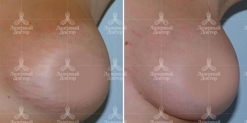 Лечение растяжек лазером (фото до и после)
