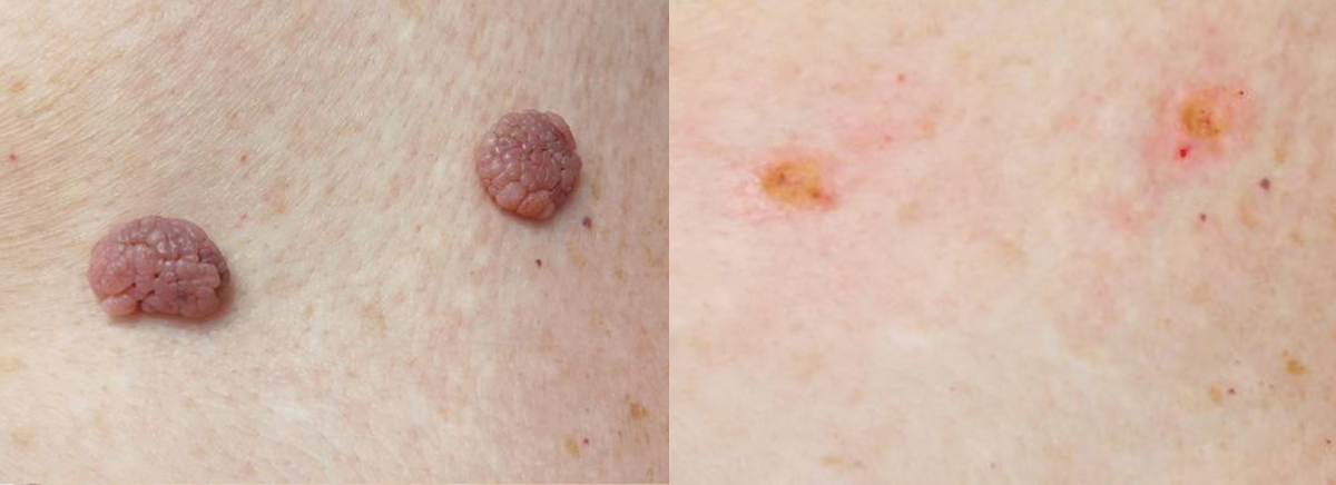 удаление новообразования