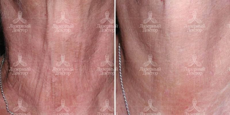 Фраксель (до и после)