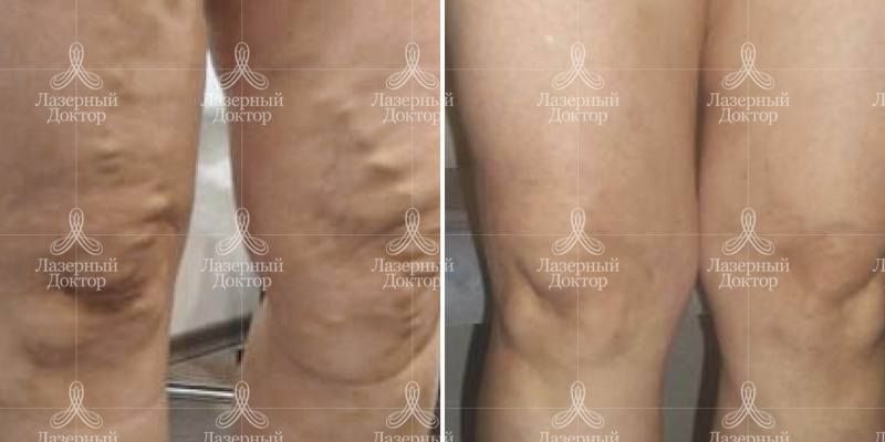 Эндовенозная лазерная облитерация варикозных вен