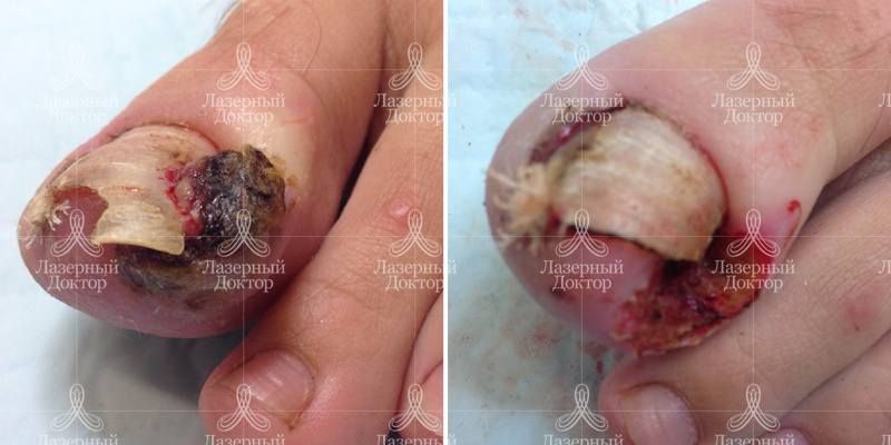 Удаление вросшего ногтя лазером