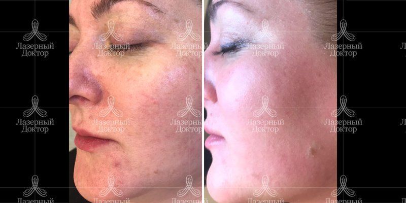 ДОТ лазерная шлифовка