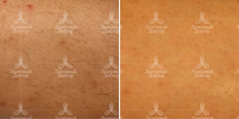 Голени после удаления волос лазером (было и стало)