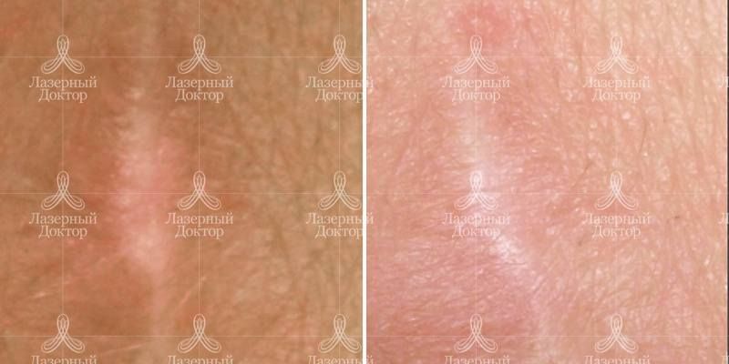 Шлифовка лазером рубцов и шрамов (фото)