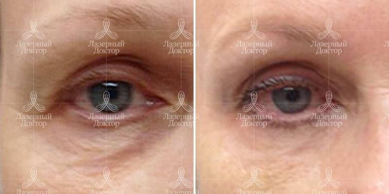 Контурная пластика носослезных борозд