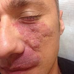 Удаление гемангиомы