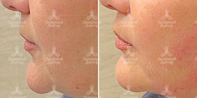 Лифтинг лица мезонитями (фото до и после)