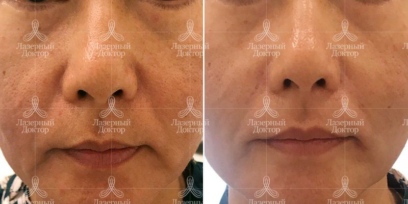Контурная пластика носогубных складок