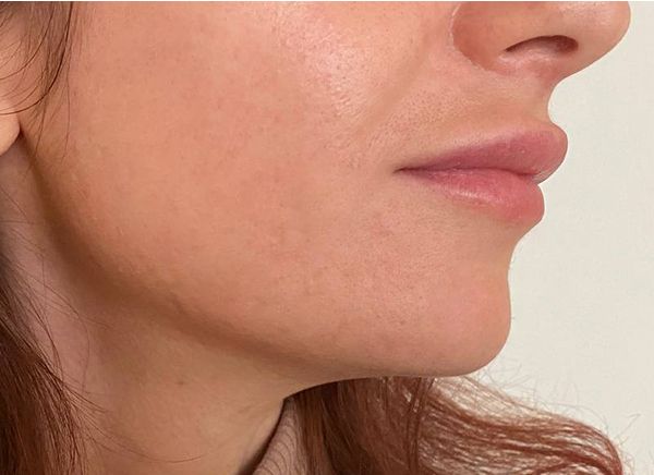 Избавление от акне после