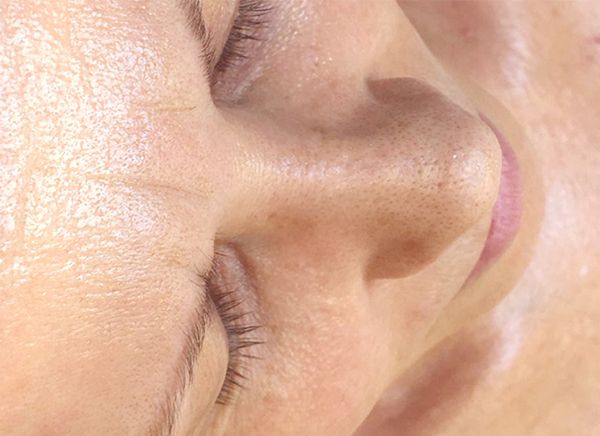 Ультразвуковая чистка лица фото до и после