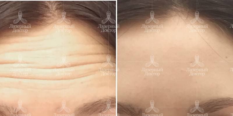 Ботокс на лоб: фото до и после