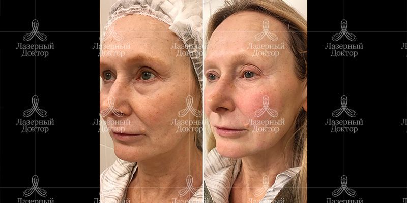 Термаж лица