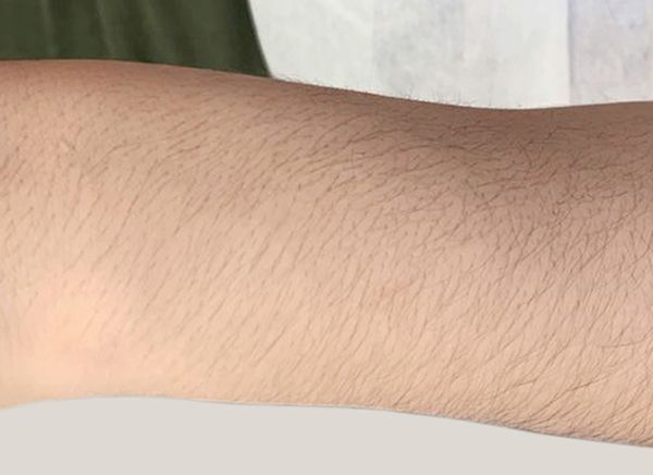 Лазерная эпиляция фото до и после