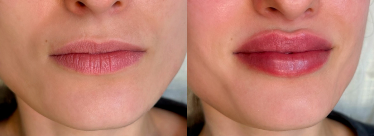 Контурная пластика губ Stylage