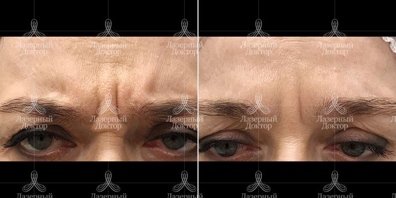 Удаление мимических морщин