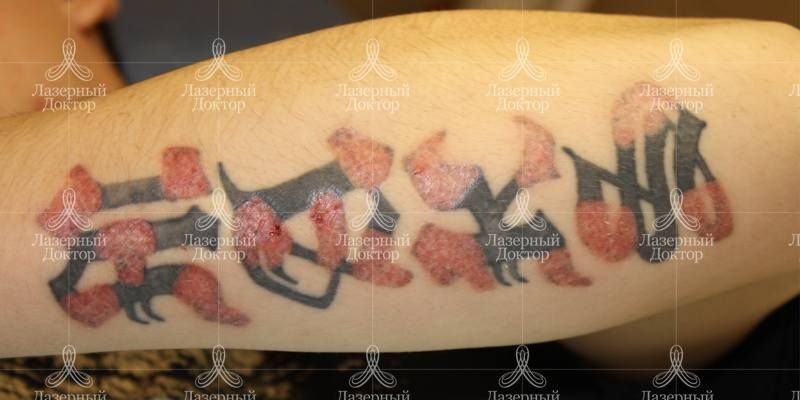 Выведение тату: результаты