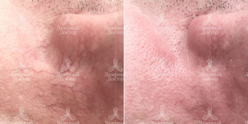 Удаление сосудов