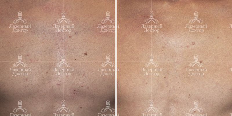 Лазерная эпиляция motus ax в зоне груди (фото)