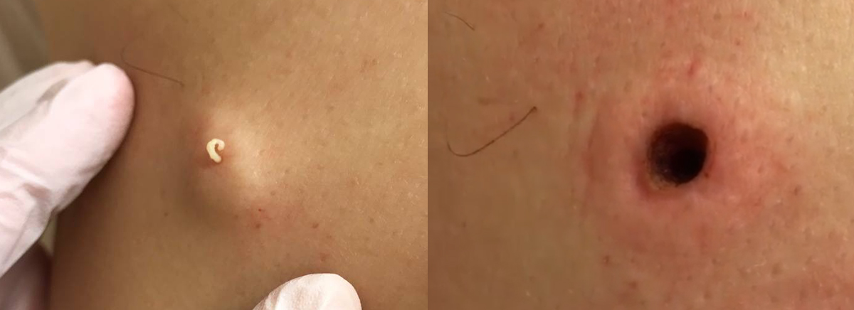 удаление новообразования