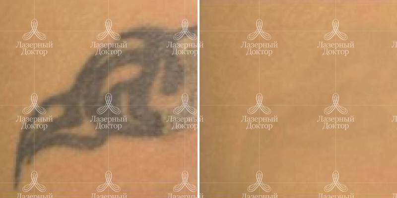 Свести тату лазером (фото)