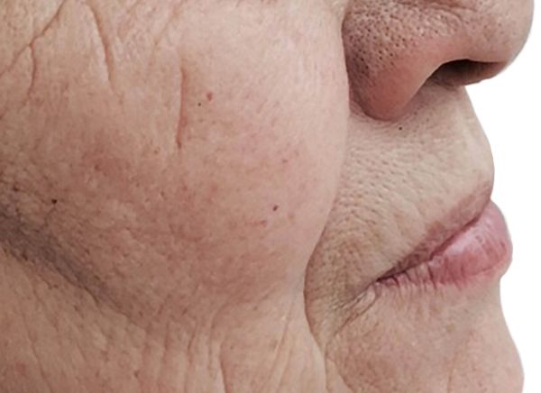 3D-волюмизация фото до и после