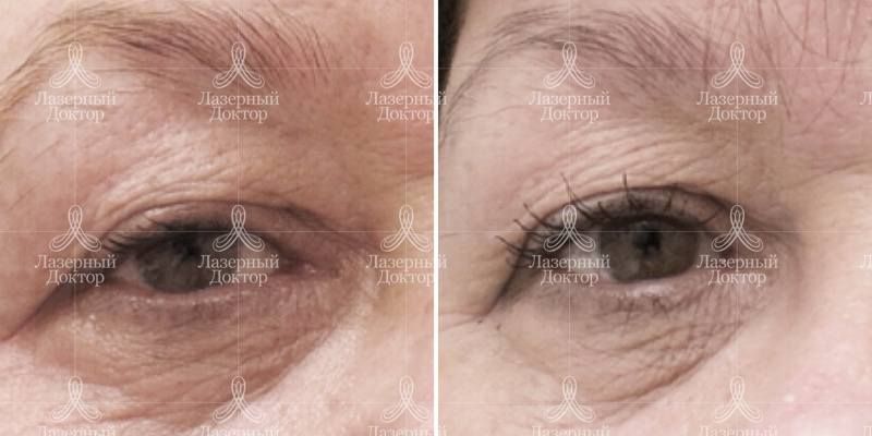 dot омоложение зоны глаз