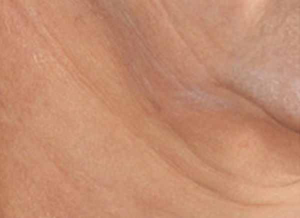 3D-волюмизация фото до и после