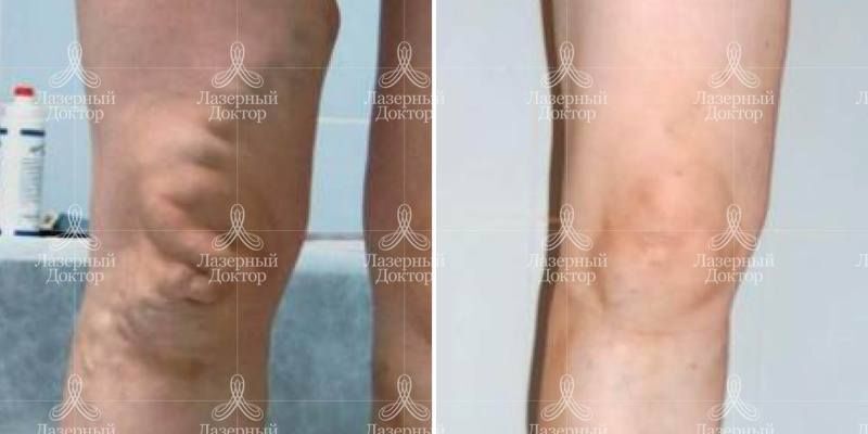 Фото до и после лазерной облитерации вен нижних конечностей