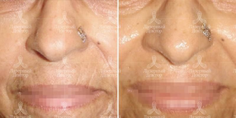 infini волюмизация