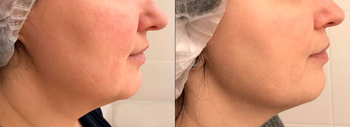 SMAS-лифтинг ULTRAFORMER