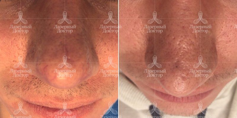 IPL-фотолечение Quantum